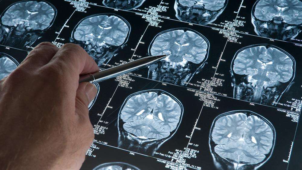 Alzheimer May Begin Decades Before Symptoms Appear
