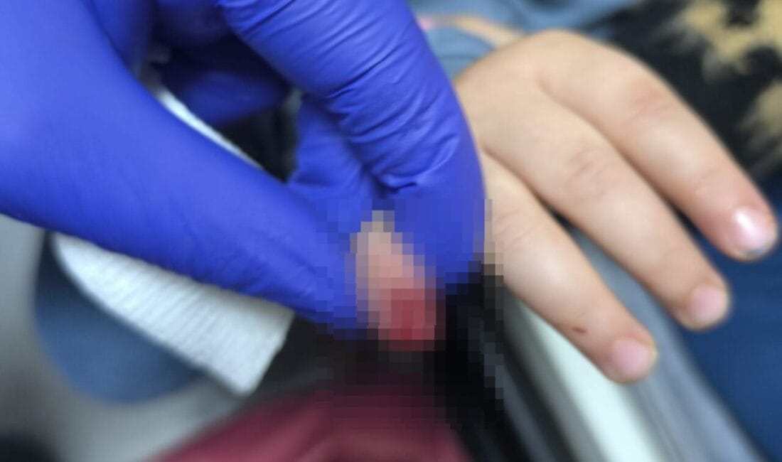 AVM’de Kaza: 3 Yaşındaki Çocuğun Parmağı Koptu Mardin’de AVM’de yürüyen merdivene eli sıkışan 3 yaşındaki çocuğun kopan