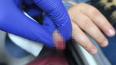 Mardin’de AVM’de yürüyen merdivene eli sıkışan 3 yaşındaki çocuğun kopan
