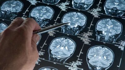 Yeni bir araştırma, Alzheimer hastalığının belirtiler ortaya çıkmadan yıllar önce
